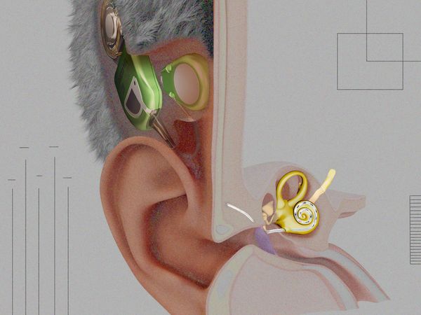全球首款全植入式人工耳蜗问世，患者实现全天候隐形听力