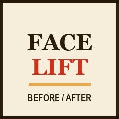 Facelift